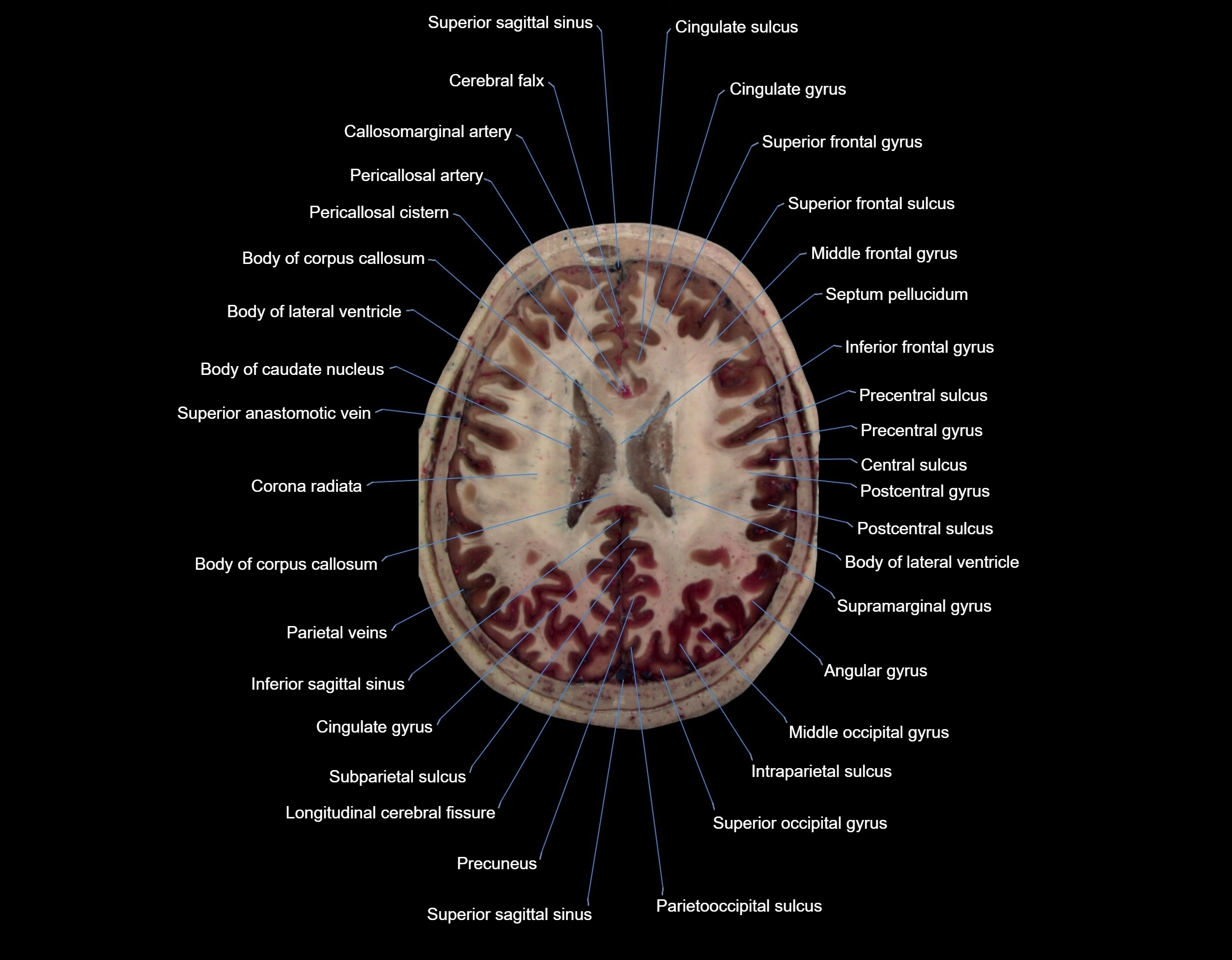 MRI Brain axial cross sectional radiology anatomy 3T image  -img-000052.webp